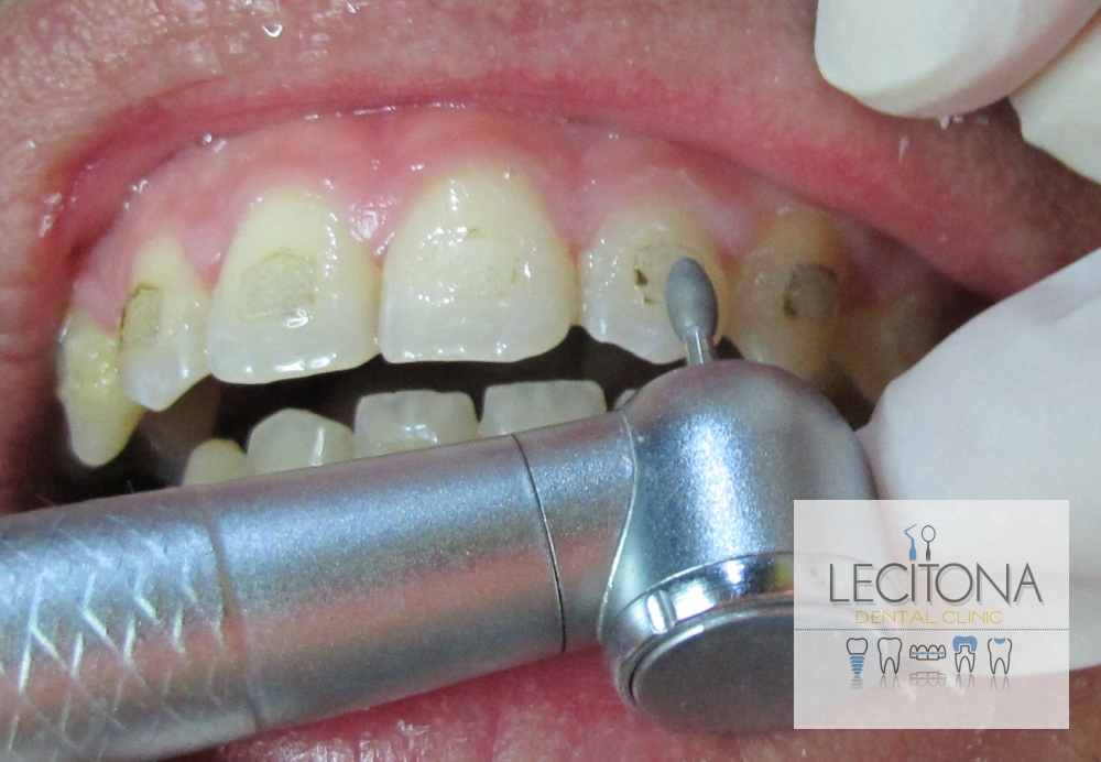 DIY Braces Removal: Why It's Dangerous and What to Do Instead